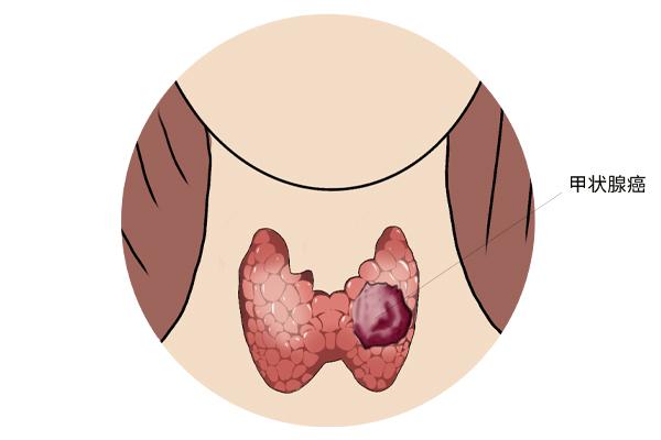 甲狀腺癌癥的主要癥狀表現(xiàn)有什么？為什么會(huì)得甲狀腺癌癥呢？