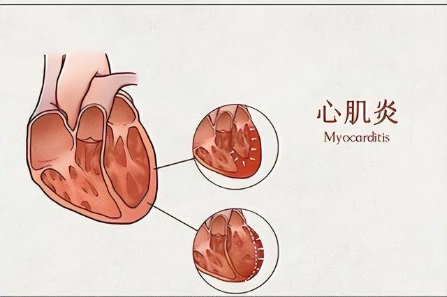 心肌炎的癥狀有哪些？心肌炎的主要變現(xiàn)癥狀有啥？